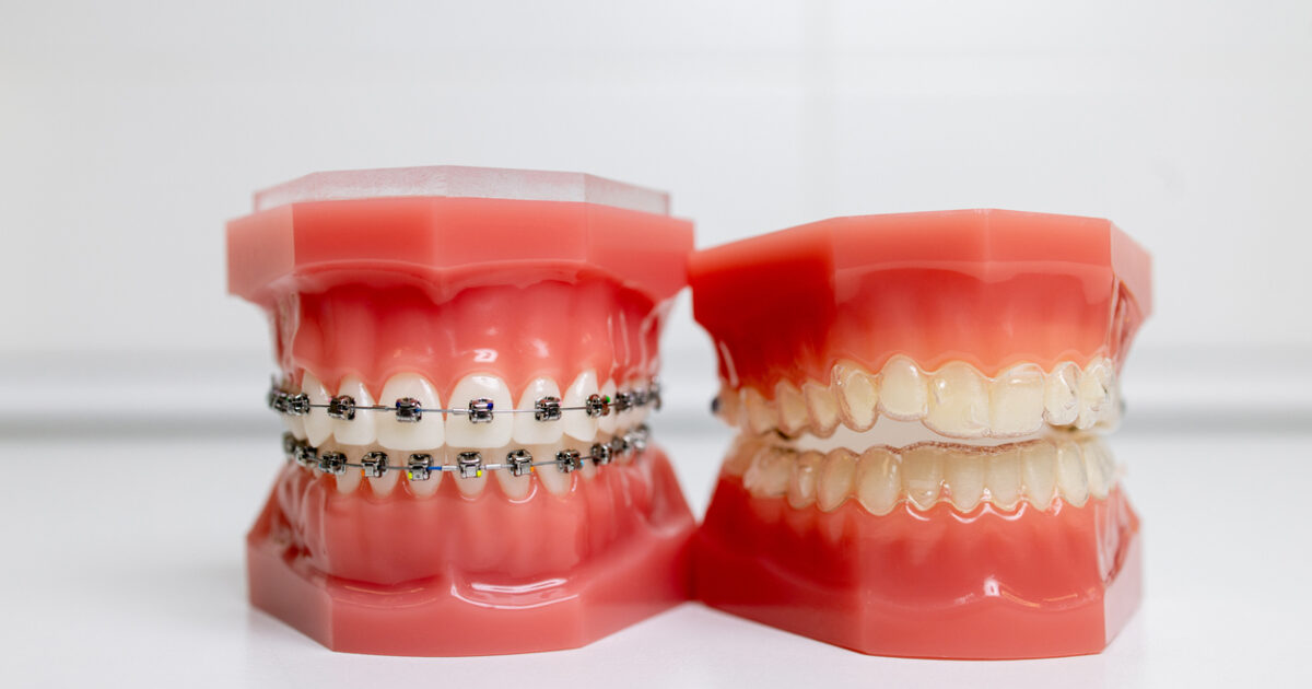 Invisalign vs Fixed Braces  Longfellow Road Dental Practice